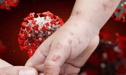 Maymun çiçeği (mpox) virüsü hızla yayılıyor