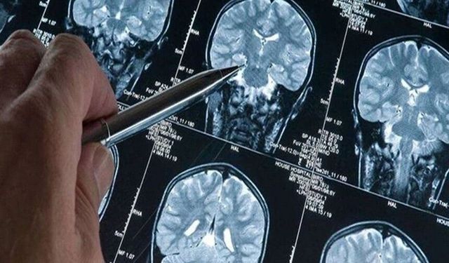 Alzheimer tedavisinde umut veren gelişme...